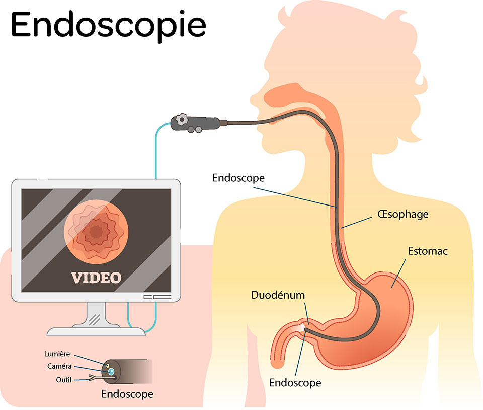 Endoscopie ou Fibroscopie examen, déroulement et suites Elsan
